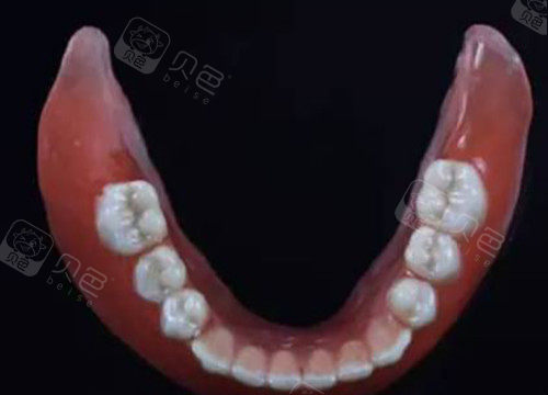 吸附性全口义齿