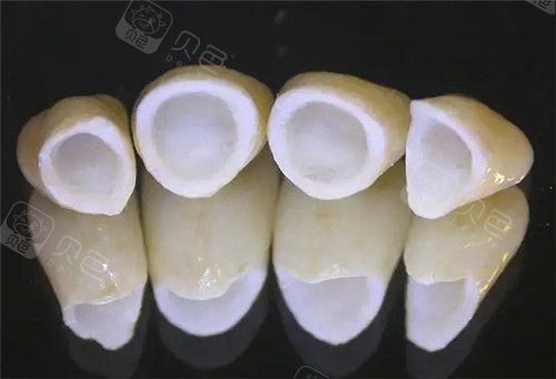全瓷牙连桥冠照片