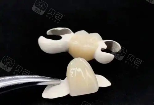 hpp粘接桥牙齿示意图