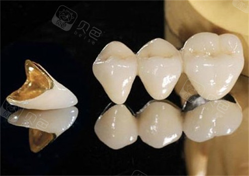 单颗烤瓷牙和连冠烤瓷牙