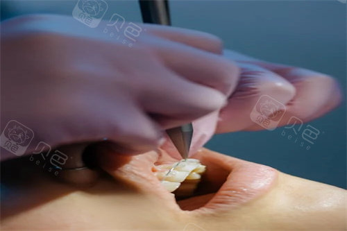 牙齿矫正操作中