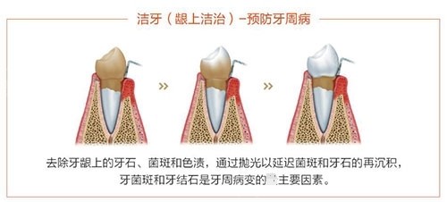 被医生骗了龈下刮治的多吗？龈下刮治后牙龈会重新包紧牙吗？